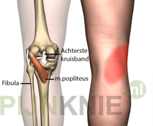 Knieholte pijn bij het lopen – de rol van de m. popliteus
